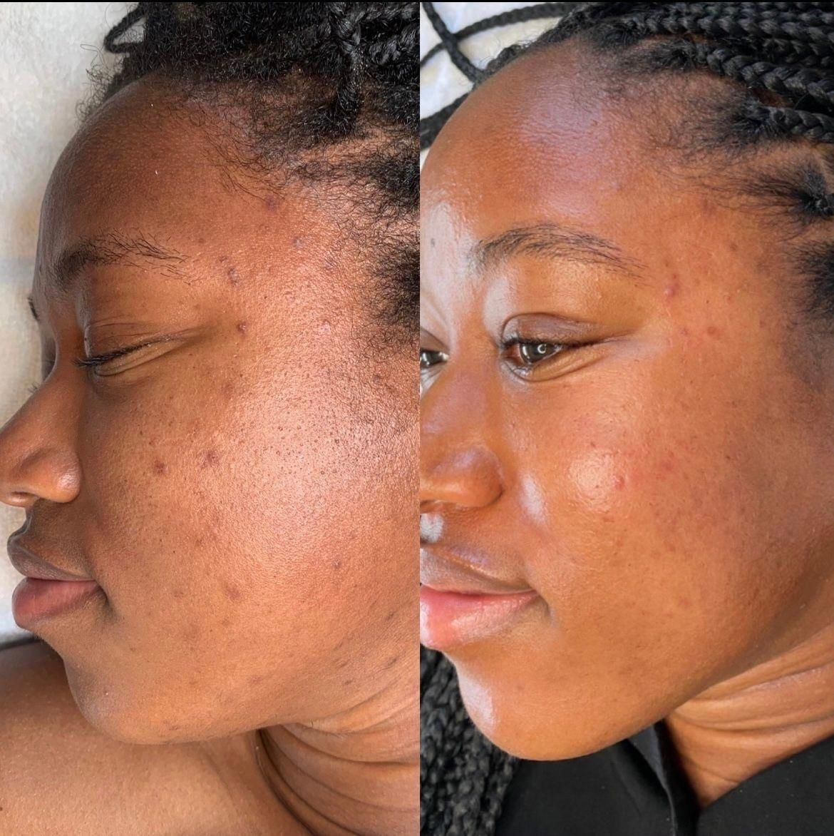 Turmeric & Kojic Acid Skincare Set