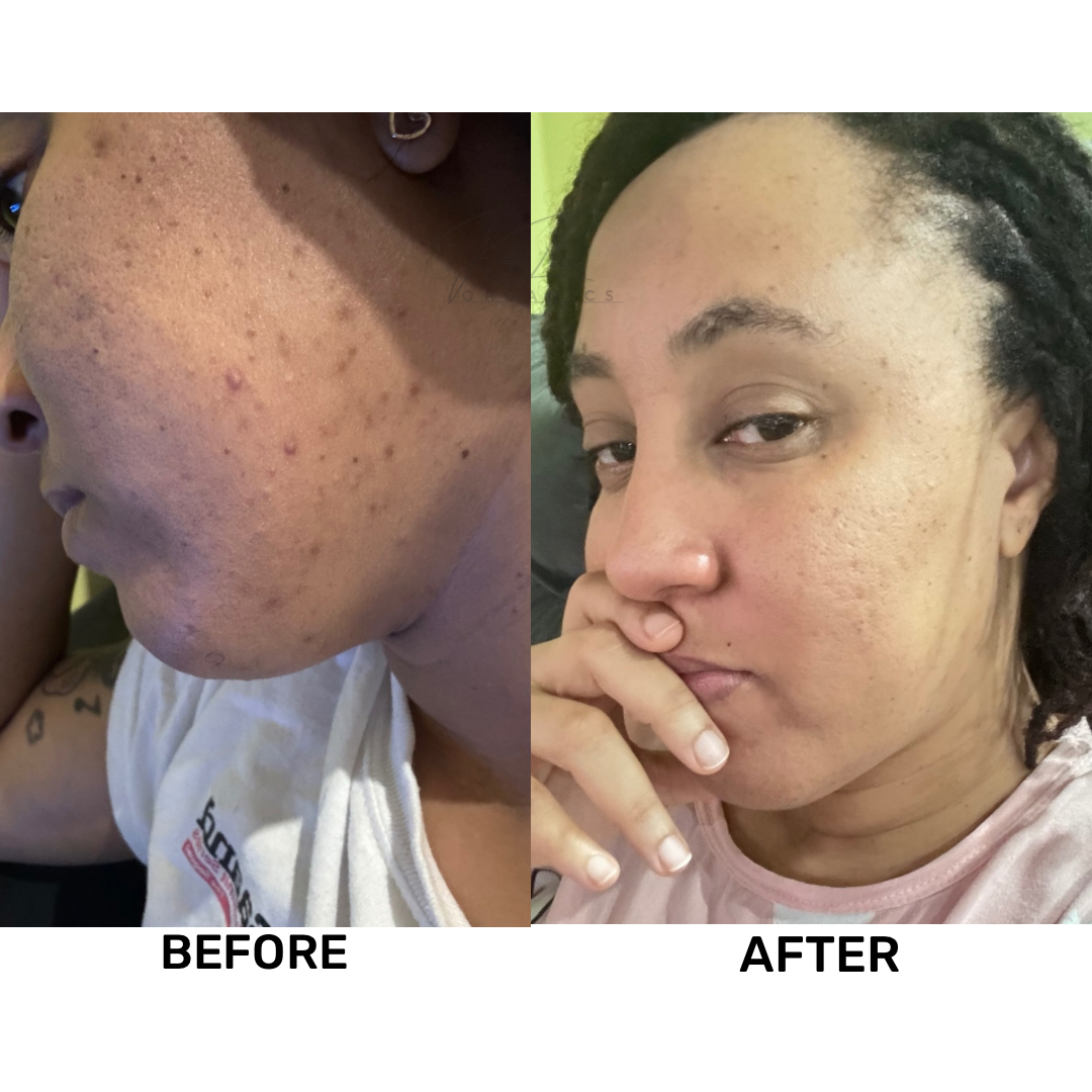 Turmeric & Kojic Acid Skincare Set